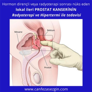 Hormon Dirençli veya Radyoterapi Sonrası Nüks Eden Lokal İleri Prostat Kanserinin Radyoterapi ve Hipertermi ile Tedavisi