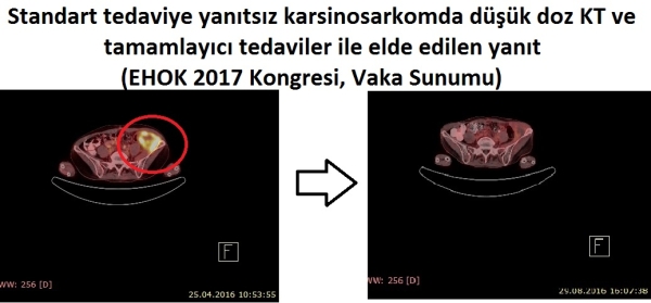 Kanser Tedavisinde Bütüncül Tedavi: İmmunoonkotermi
