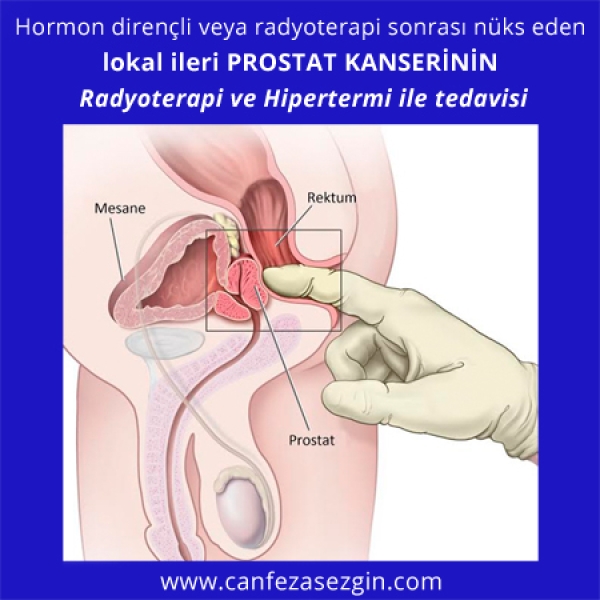 Hormon Dirençli veya Radyoterapi Sonrası Nüks Eden Lokal İleri Prostat Kanserinin Radyoterapi ve Hipertermi ile Tedavisi